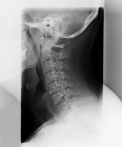 Phase 1 Cervical curve